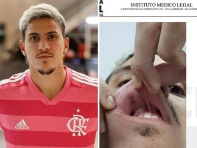 Pedro Guilherme: Saiba tudo sobre a agressão ao atacante do Flamengo